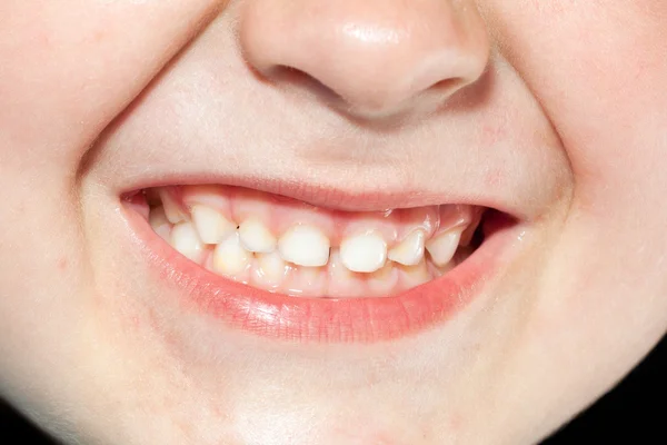 Детские зубы закрываются. — стоковое фото
