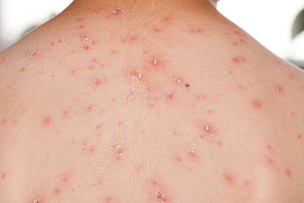 Detail baby with chicken pox rash
