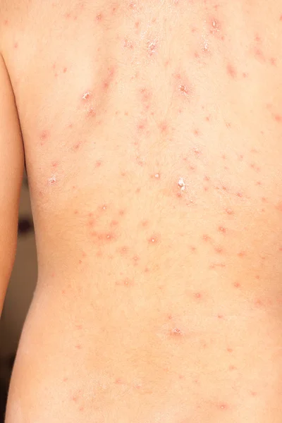 Detail baby with chicken pox rash — Stock Photo, Image