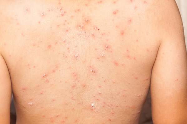 Detail baby with chicken pox rash