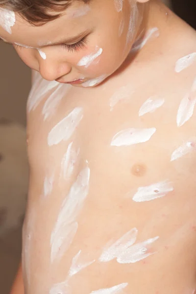 Detail baby with chicken pox rash — Stock Photo, Image