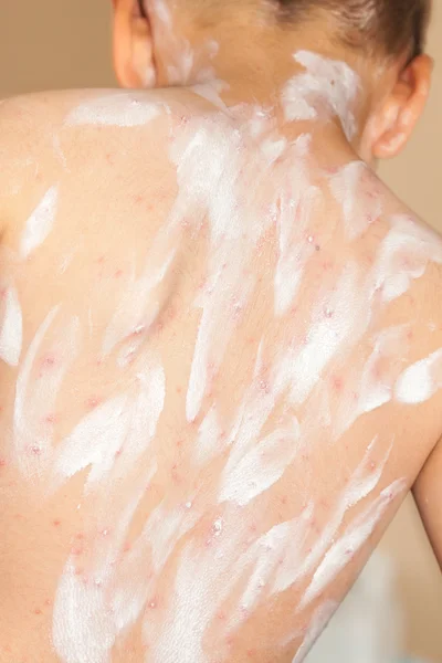 Dettaglio bambino con rash da varicella — Foto Stock