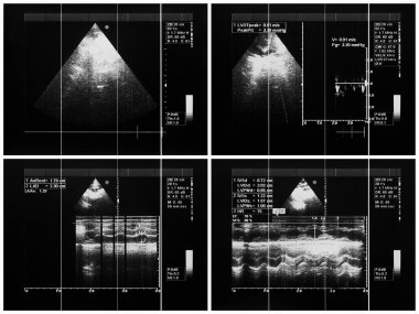 Cardiac ultrasound images, color Doppler echo clipart