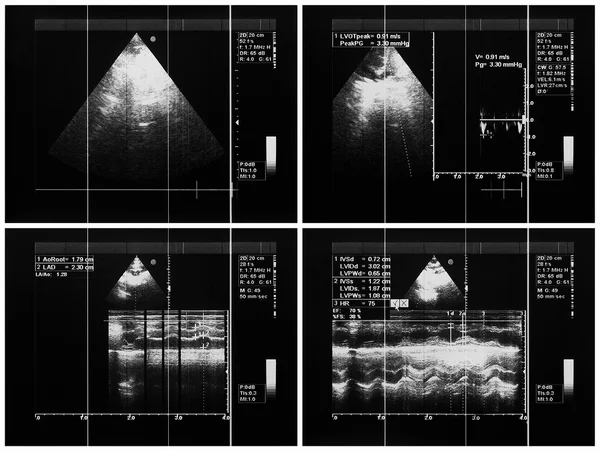 Imagens de ultrassom cardíaco, eco Doppler colorido — Fotografia de Stock