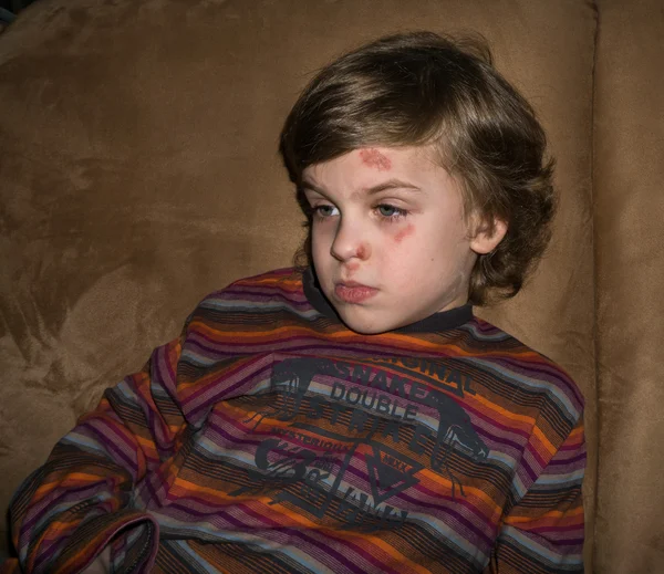 Pojke med blåmärke och repa på ansiktet — Stockfoto