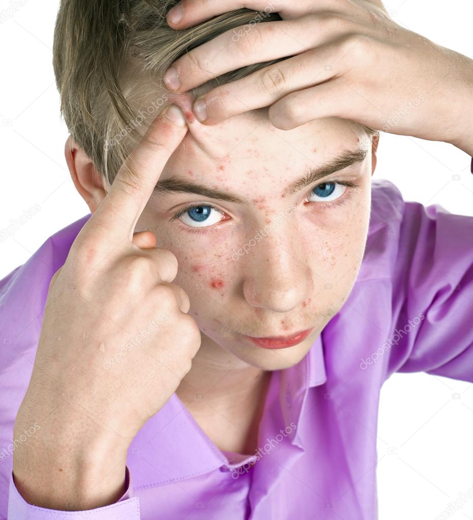 Teenager with acne on his face.