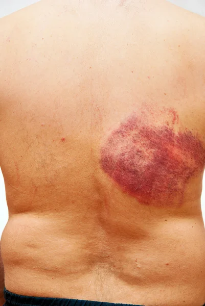 Hematoma on a back — Stock Photo, Image