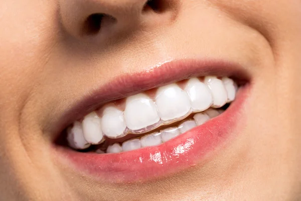 Menina sorrindo usando aparelho de dentes invisíveis — Fotografia de Stock