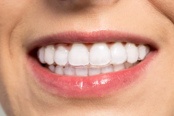 Woman wearing orthodontic silicone trainer — Stock Photo, Image