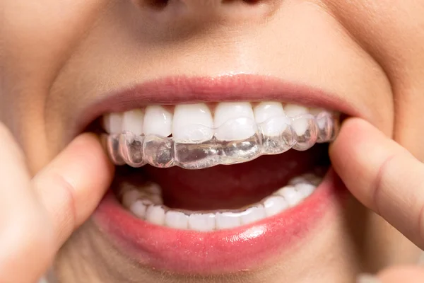 Wearing orthodontic silicone trainer — Stock Photo, Image