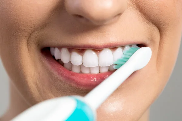 Limpeza e clareamento dos dentes — Fotografia de Stock