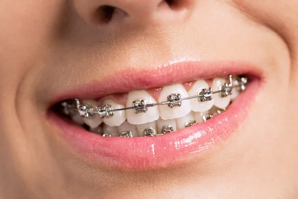 Sorriso de sucesso feliz com dentes e aparelhos perfeitos — Fotografia de Stock