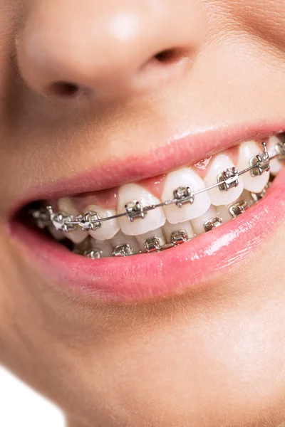 Happy smiling healty woman with braces — Stock Photo, Image