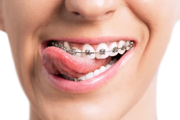 Smiling mouth with tongue and braces — Stock Photo, Image