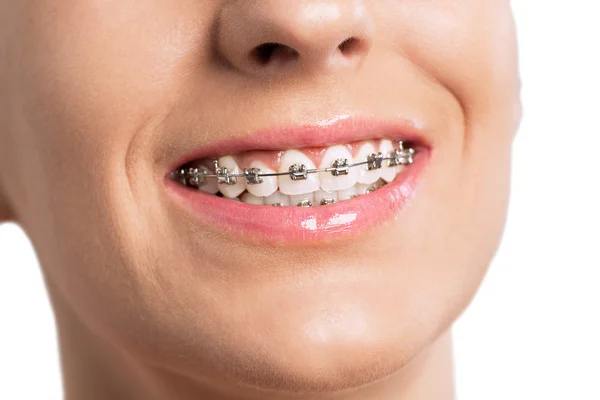 Boca feminina sorridente com aparelho nos dentes — Fotografia de Stock