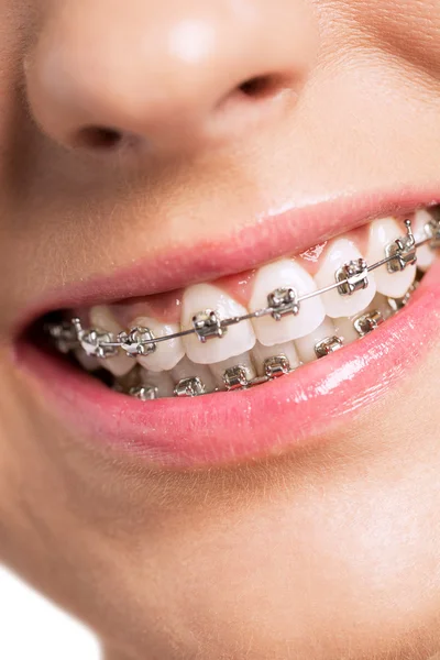 Happy smiling healty woman with braces Stock Photo