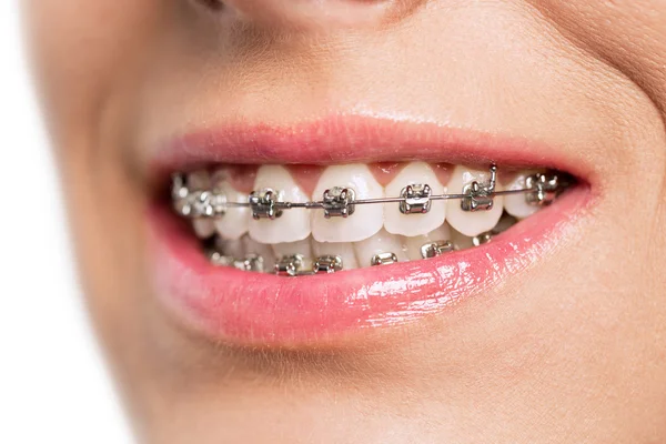 Teeth with braces Stock Image