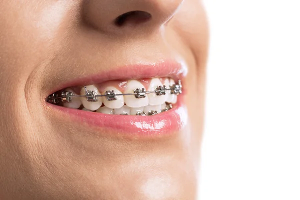 Close up of braces girls teeth Stock Picture