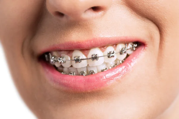 Prety girl smiling with braces Royalty Free Stock Photos