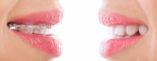 Sağlıklı mutlu gülümseme diş teli ile