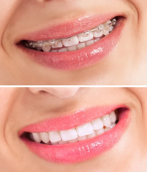 Denti perfetti prima e dopo l'apparecchio — Foto Stock