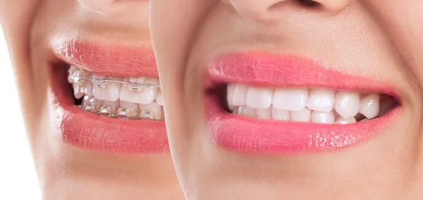 Gigi yang indah setelah perawatan kawat gigi — Stok Foto
