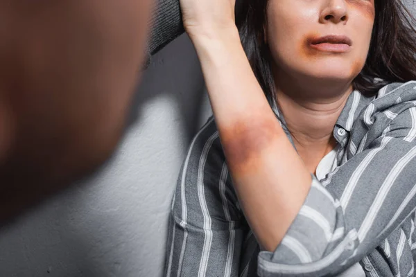Vista cortada da vítima de violência doméstica com hematomas perto do marido em primeiro plano desfocado — Fotografia de Stock