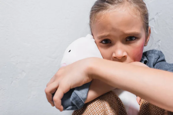 Offended kid with bruise on cheek hugging soft toy and looking at camera — Stock Photo