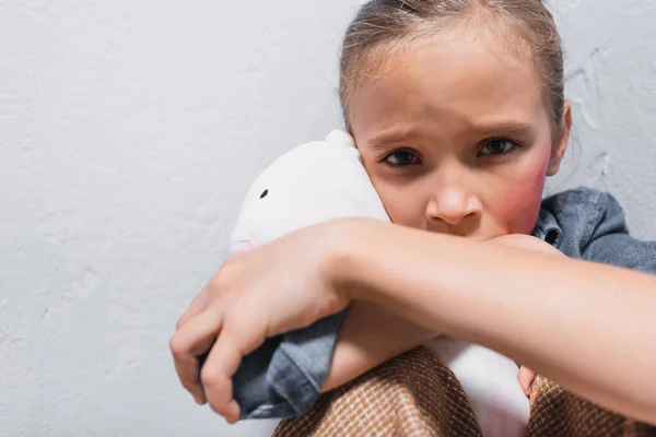 Enfant offensé avec ecchymose sur la joue étreignant jouet doux et regardant la caméra — Photo de stock