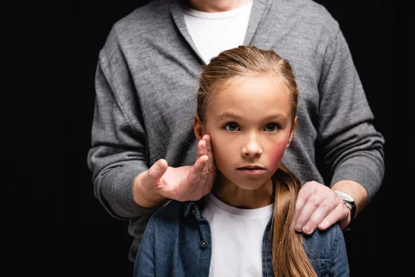 Abusive father hugging and touching cheek of daughter with bruise isolated on black — Stock Photo