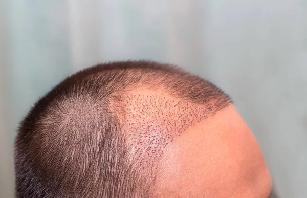 Top view of a man\'s head with hair transplant surgery with a receding hair line. -  After Bald head of hair loss treatment.