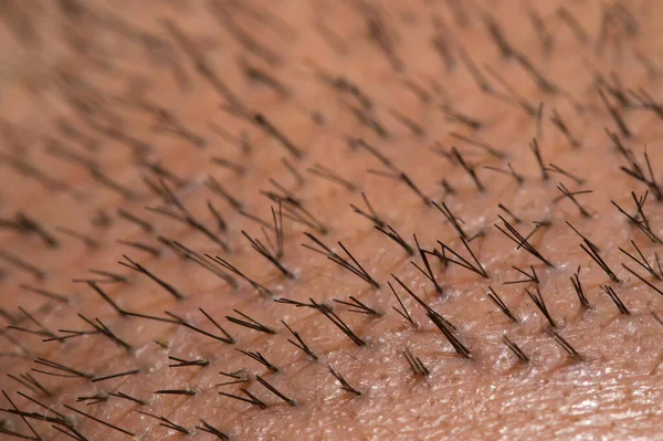 Close up top view of a man's head with hair transplant surgery with a receding hair line. -  After Bald head of hair loss treatment.