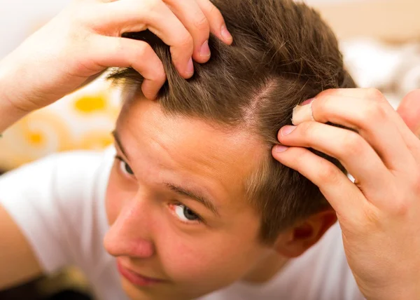 A perda de cabelo vem mesmo na juventude — Fotografia de Stock