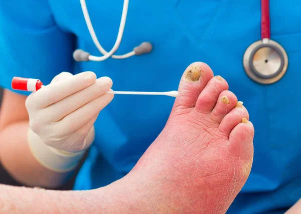 Taking Sample From Nail Fungus — Stock Photo, Image