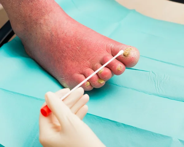 En la dermatología con infección fúngica crónica — Foto de Stock