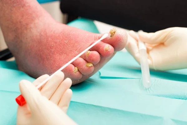 Examen dermatologique sur jambe artériosclérotique avec ongle F — Photo