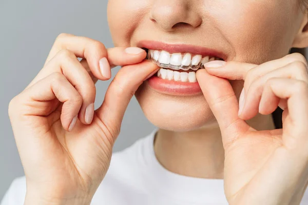 Una mujer joven hace un procedimiento de blanqueamiento de dientes en casa. Bandeja blanqueadora con gel — Foto de Stock