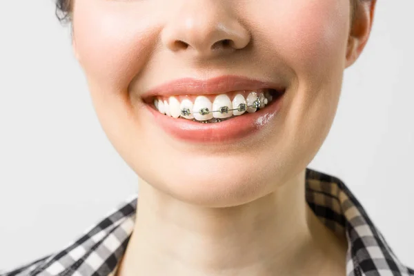 Tratamento Ortodôntico. Conceito de Assistência Dentária. Mulher bonita Sorriso saudável perto. Fechar suportes de cerâmica e metal nos dentes. Sorriso feminino bonito com aparelho. — Fotografia de Stock
