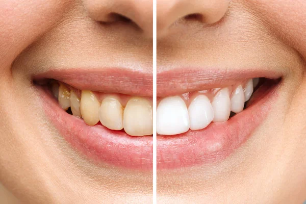 Woman teeth before and after whitening. Over white background. Dental clinic patient. Image symbolizes oral care dentistry, stomatology. — Stock Photo, Image