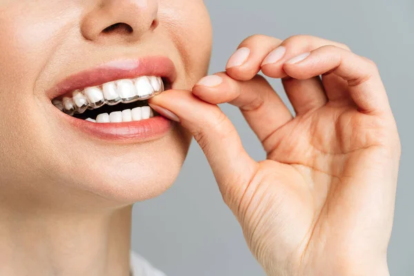 Una mujer joven hace un procedimiento de blanqueamiento de dientes en casa. Bandeja blanqueadora con gel — Foto de Stock