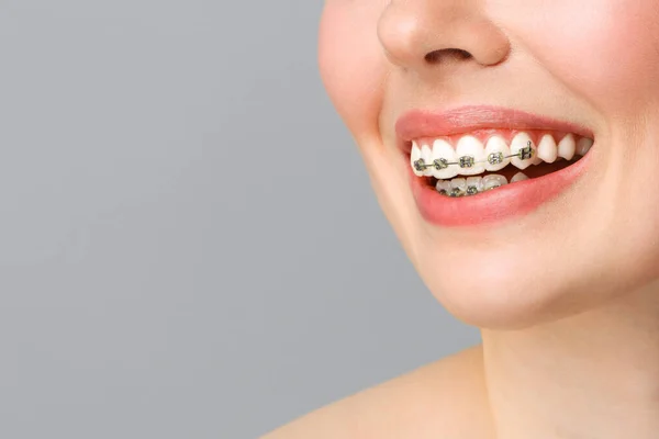 Ortodontická léčba. Pojetí zubní péče. Krásná žena zdravý úsměv zblízka. Detailní keramické a kovové držáky na zuby. Krásný ženský úsměv s rovnátky. — Stock fotografie