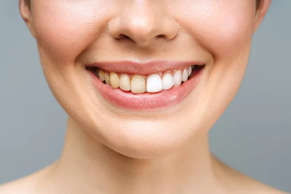 Žena zuby před a po bělení. Přes bílé pozadí. Pacient na zubní klinice. Obrázek symbolizuje ústní péči, stomatologii. — Stock fotografie