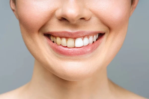 Dientes de mujer antes y después del blanqueamiento. Sobre fondo blanco. Paciente de la clínica dental. La imagen simboliza el cuidado bucal odontología, estomatología. — Foto de Stock