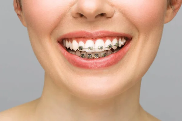 Tratamiento ortodóncico. Concepto de Cuidado Dental. Mujer hermosa sonrisa sana de cerca. Primer plano soportes de cerámica y metal en los dientes. Hermosa sonrisa femenina con tirantes. — Foto de Stock