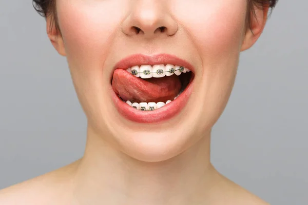 Tratamiento ortodóncico. Concepto de Cuidado Dental. Primer plano soportes de cerámica y metal en los dientes. Hermosa sonrisa femenina con tirantes. — Foto de Stock