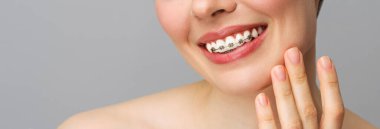 Ortodontik tedavi. Kapalı seramik ve dişlerde metal parantez. Diş telli bir kadın gülüşü. Diş sağlığı konsepti.