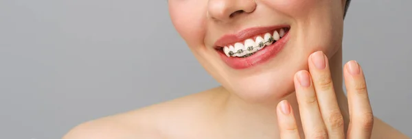 Orthodontische behandeling. Closeup keramische en metalen beugels op tanden. Vrouwelijke glimlach met beugel. Begrip tandheelkundige verzorging. — Stockfoto