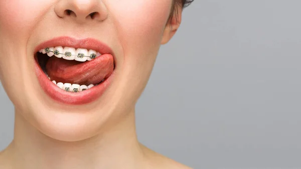 Ortodontická léčba. Detailní keramické a kovové držáky na zubech. Ženský úsměv s rovnátky. Koncept péče o zuby. — Stock fotografie