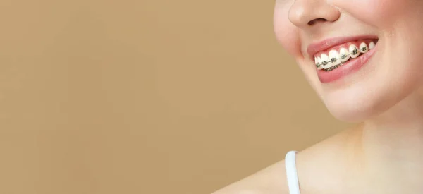 Hermosa sonrisa de una joven de cerca. Tratamiento ortodóncico. Cierre soportes cerámicos y metálicos en los dientes. Sonrisa femenina con frenillos. Concepto de cuidado dental. — Foto de Stock