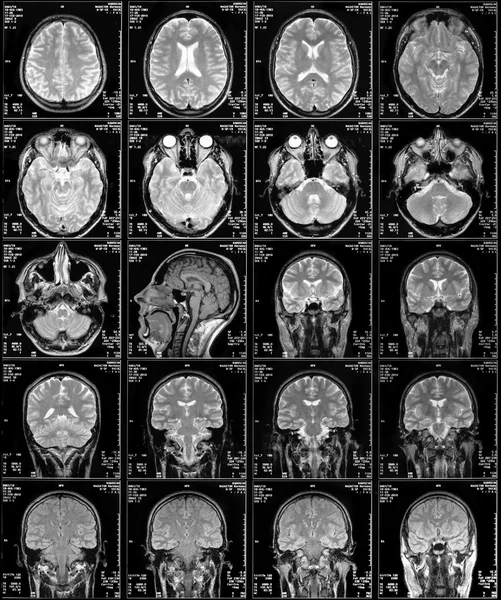 Распечатать снимки мрт. Мрт 1. Пленка мрт. Позвоночный канал мрт. Магнито-резонансная томография головного мозга.